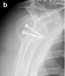 Posterior Glenoid Bone Block